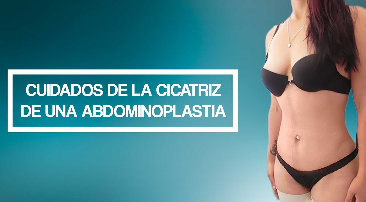 Cuidados de la cicatriz de una abdominoplastia