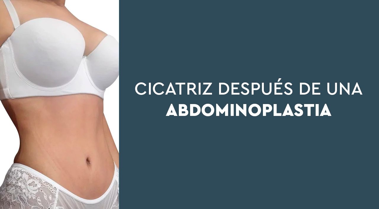 ¿De qué tamaño es la cicatriz de la abdominoplastia?