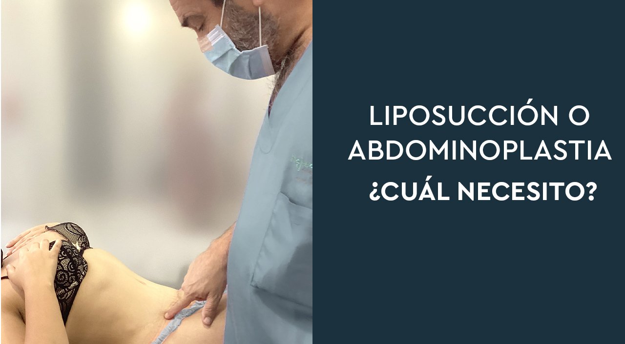 ESPUMA DESPUÉS DE UNA LIPOSUCCIÓN O ABDOMINOPLASTIA