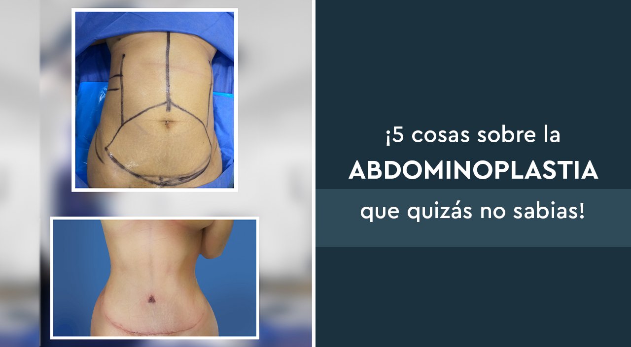 5 Cosas sobre la abdominoplastia que quizá no sabias