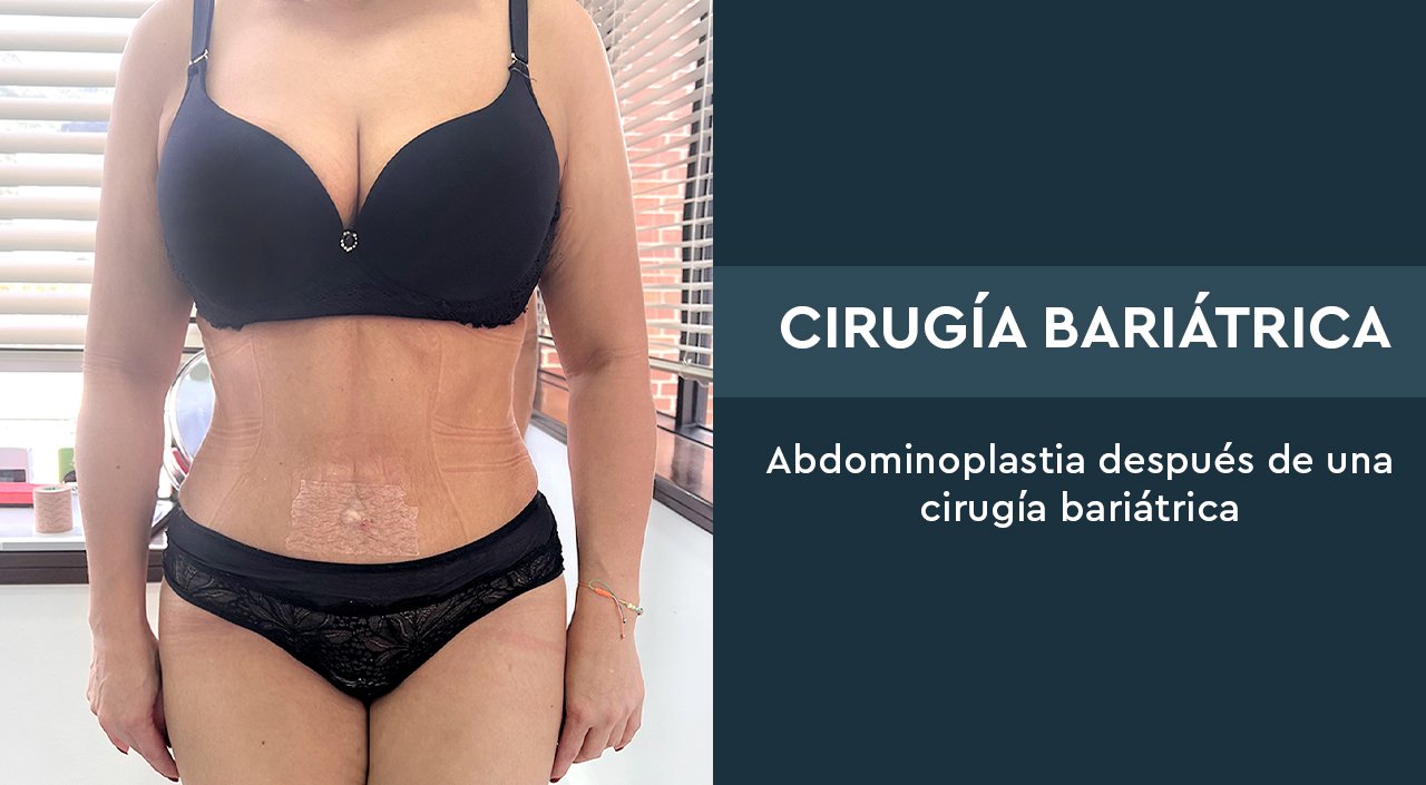 Cirugía bariátrica – Abdominoplastia después de una cirugía bariátrica