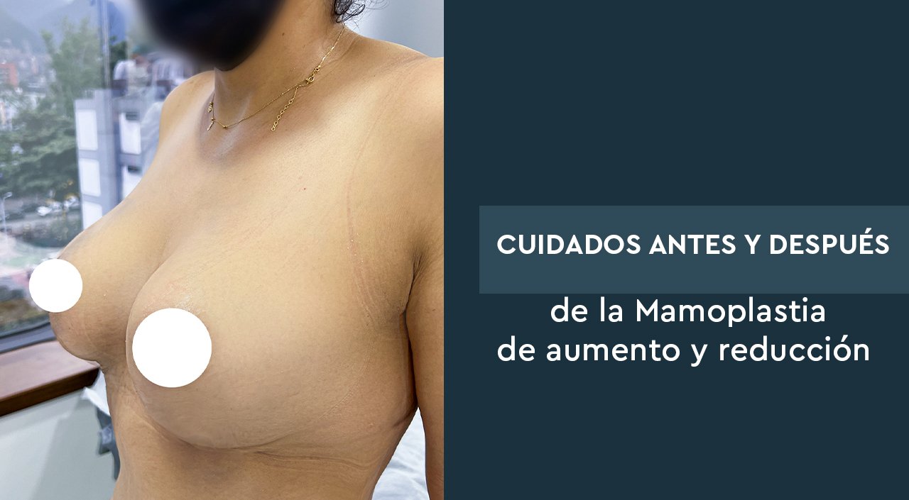 Cuidados antes y después de la Mamoplastia de aumento y reducción