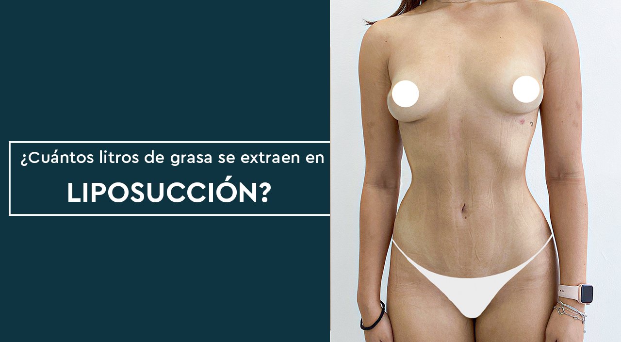 ¿Cuántos litros de grasa se extraen en la LIPOSUCCIÓN?