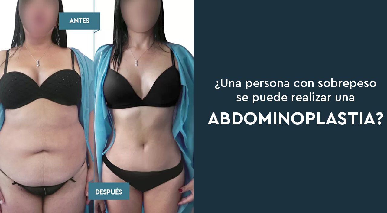6.- Abdominoplastia: ¿Una persona con sobrepeso se puede realizársela?
