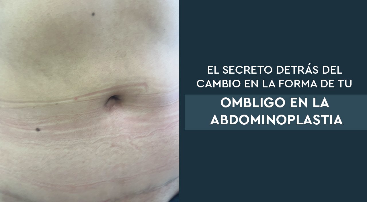 El Secreto Detrás del Cambio en la Forma de tu Ombligo en la Abdominoplastia